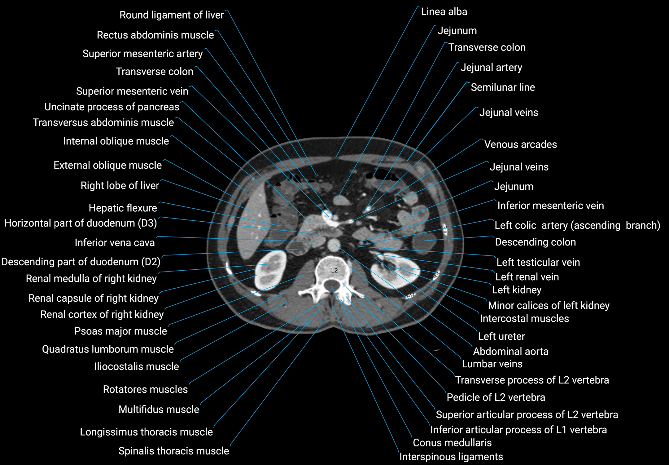 CT male pelvis axial cross sectional anatomy labelled radiology image -00072.webp
